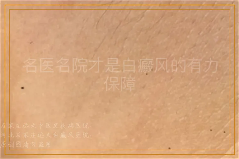 名医名院才是白癜风的有力保障