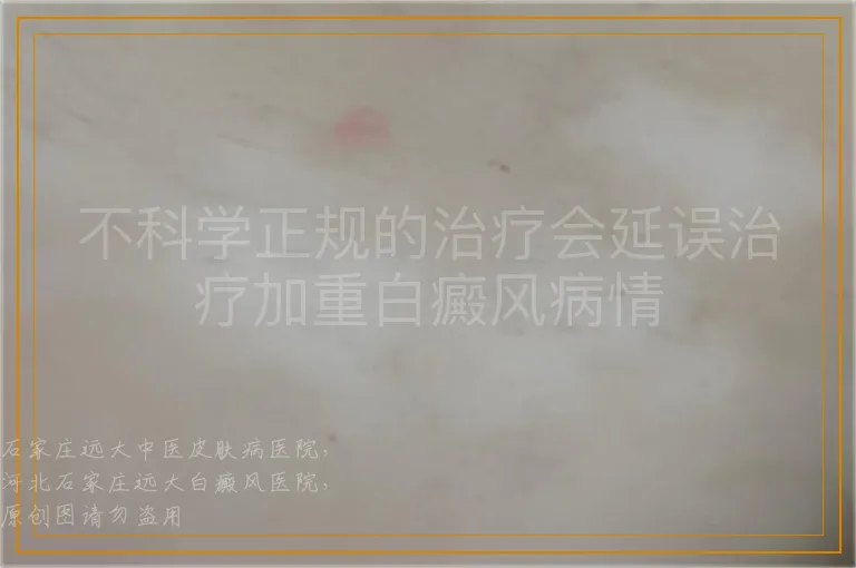 不科学正规的治疗会延误治疗加重白癜风病情