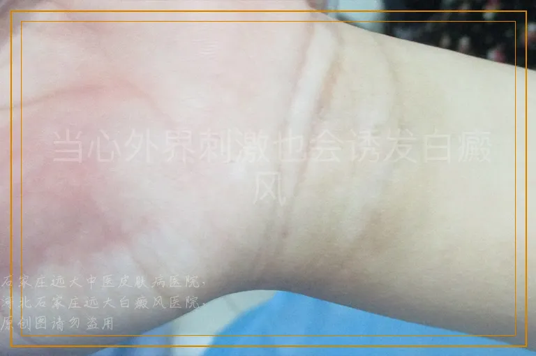 当心外界刺激也会诱发白癜风