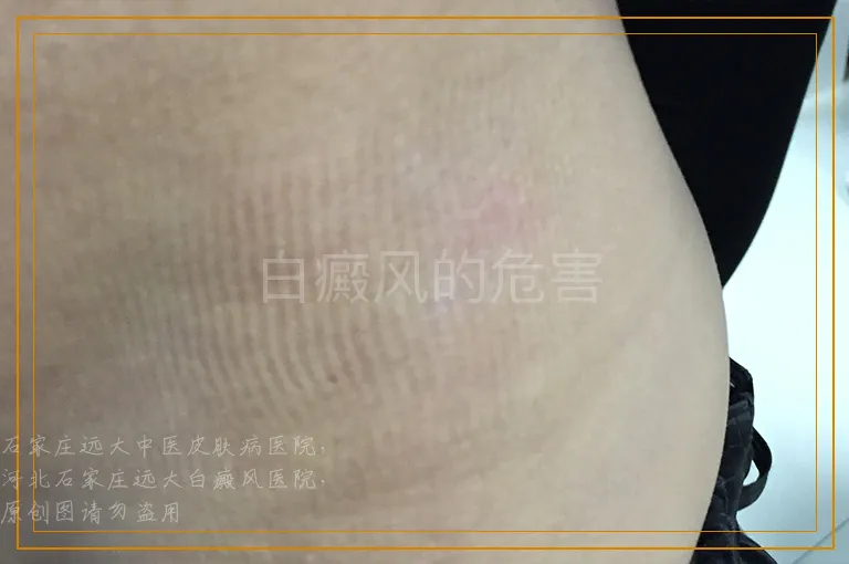 白癜风的危害
