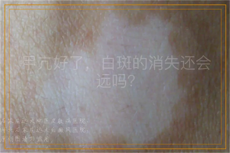 甲亢好了，白斑的消失还会远吗？
