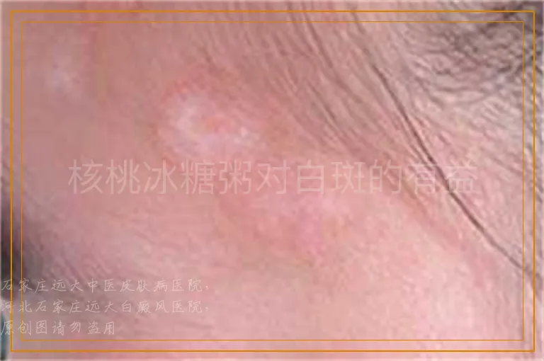 核桃冰糖粥对白斑的有益