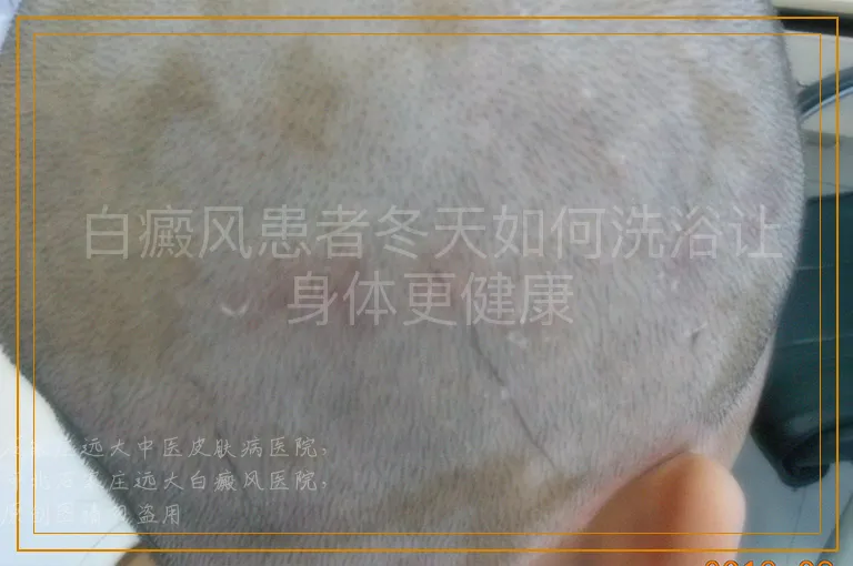 白癜风患者冬天如何洗浴让身体更健康