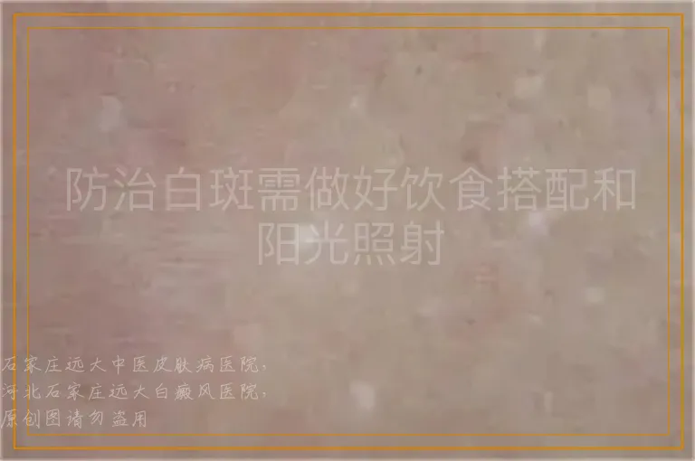 防治白斑需做好饮食搭配和阳光照射