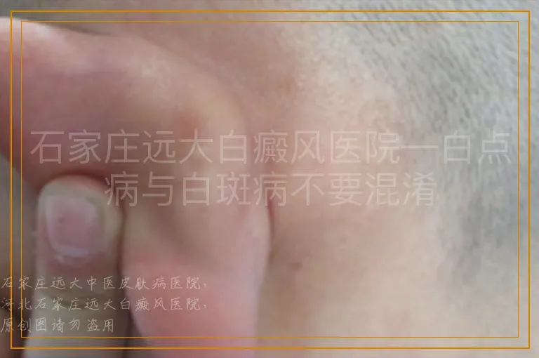 石家庄远大白癜风医院—白点病与白斑病不要混淆