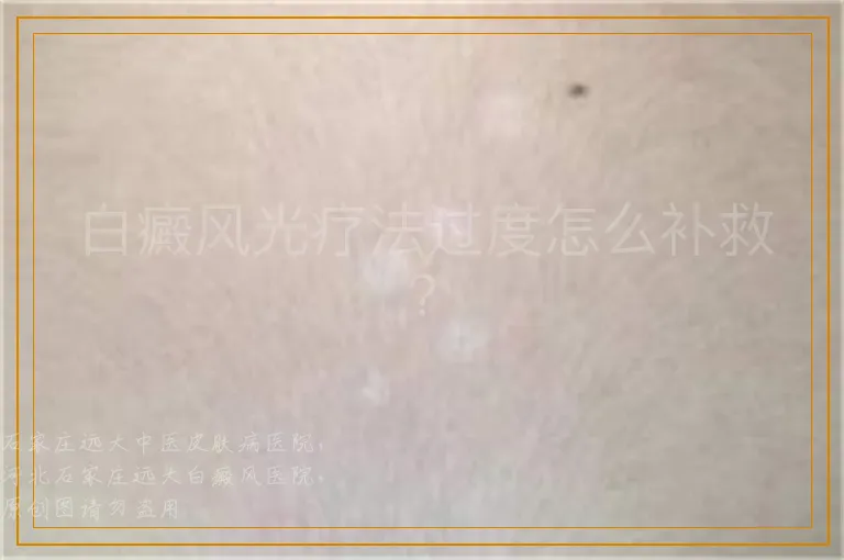 白癜风光疗法过度怎么补救？