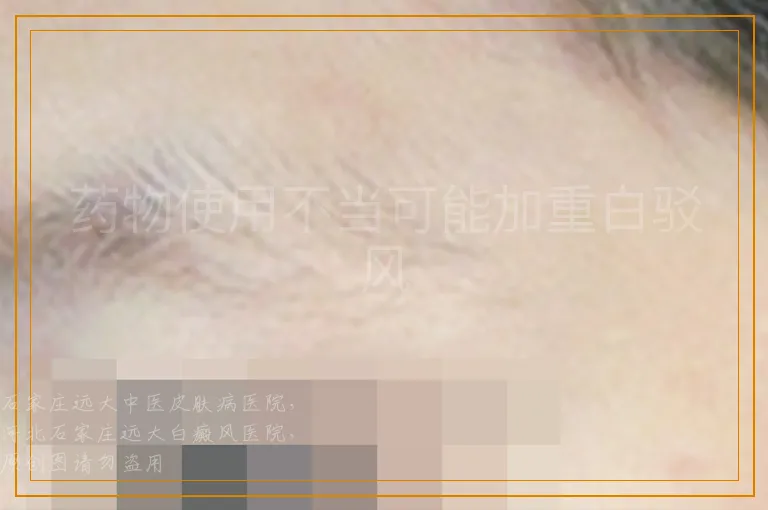 药物使用不当可能加重白驳风