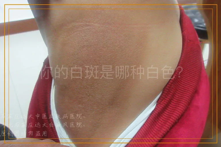 你的白斑是哪种白色？
