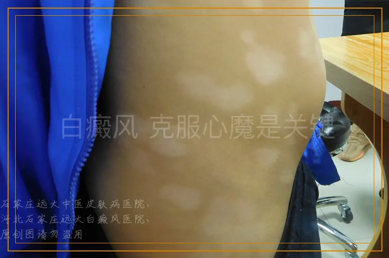 白癜风 克服心魔是关键
