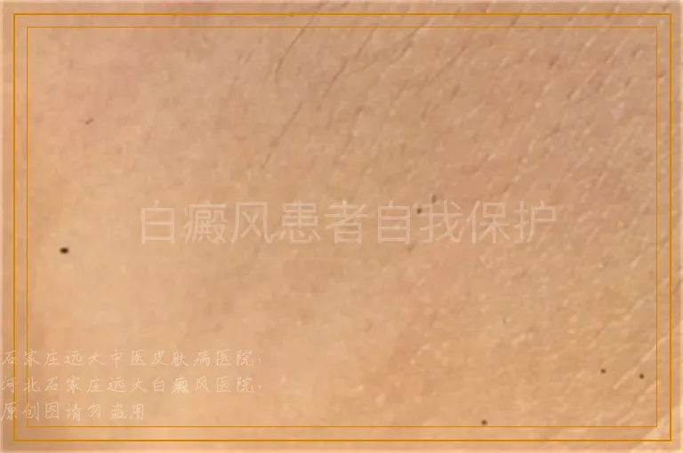 白癜风患者自我保护