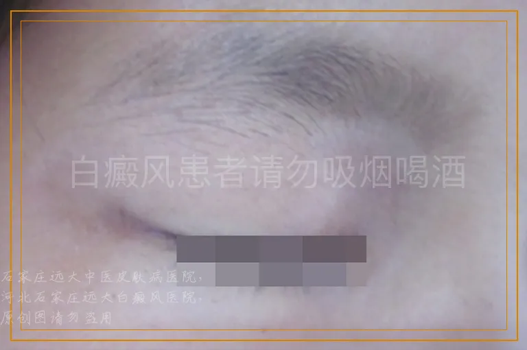 白癜风患者请勿吸烟喝酒