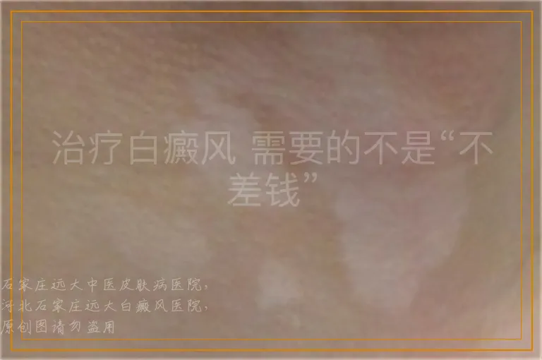 治疗白癜风 需要的不是“不差钱”