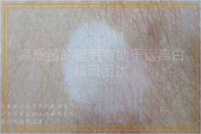 高质量的睡眠有助于远离白癜风困扰