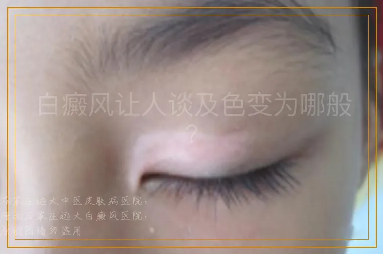 白癜风让人谈及色变为哪般？