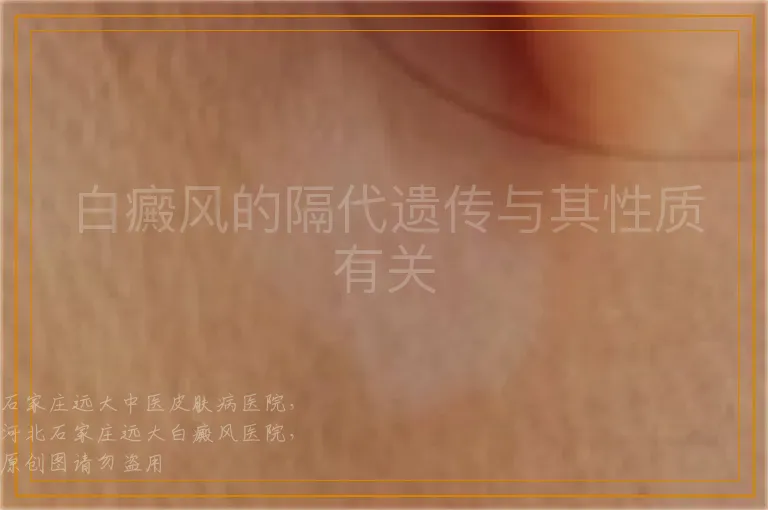 白癜风的隔代遗传与其性质有关