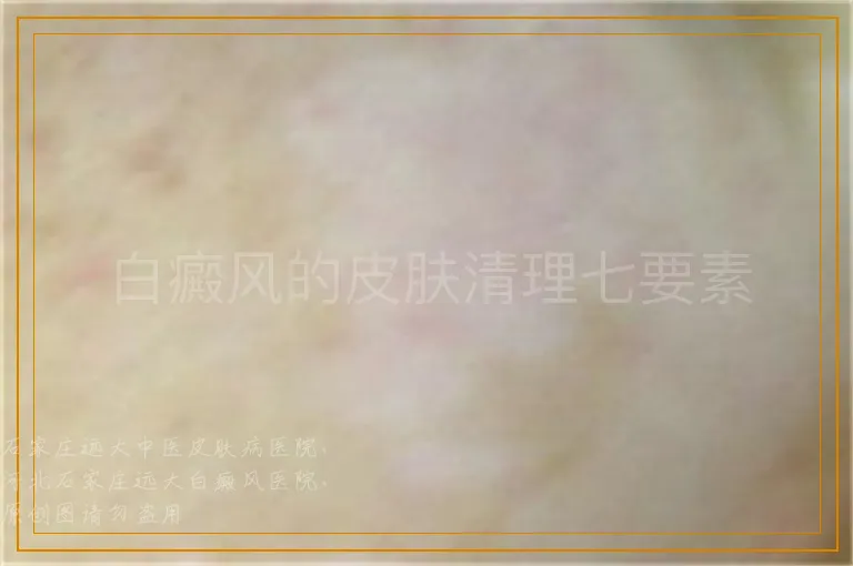 白癜风的皮肤清理七要素