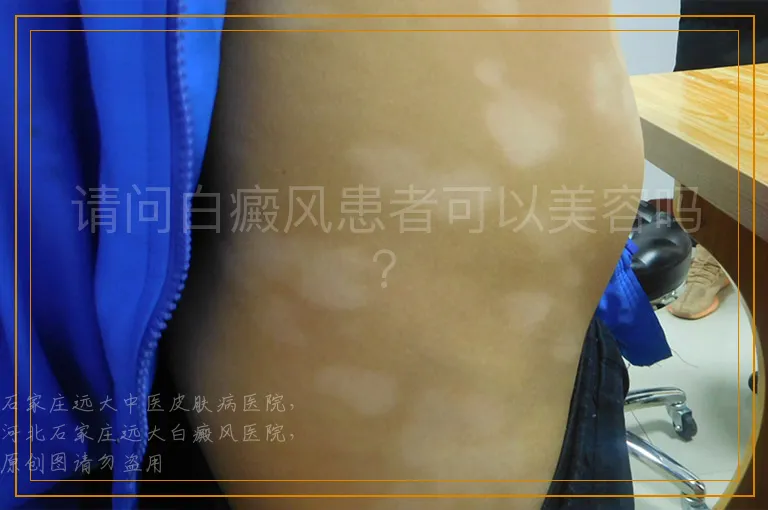 请问白癜风患者可以美容吗？