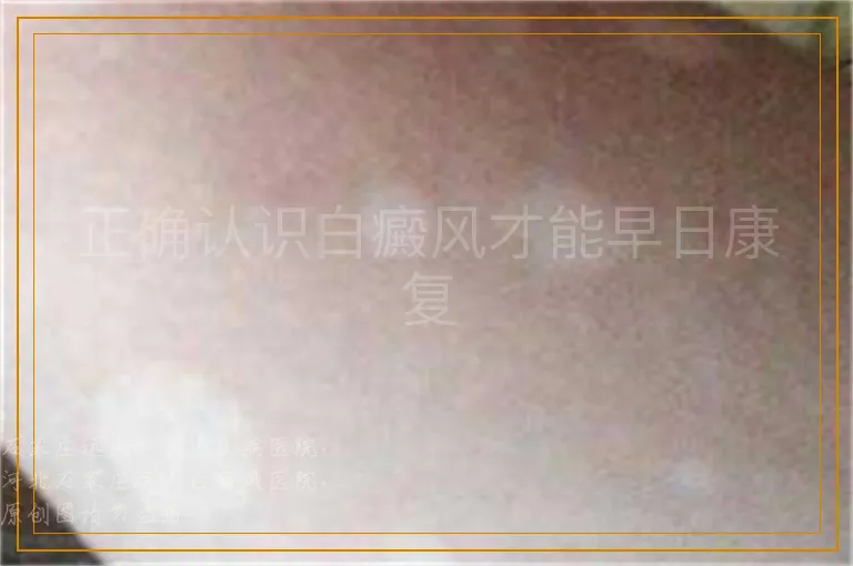 正确认识白癜风才能早日康复