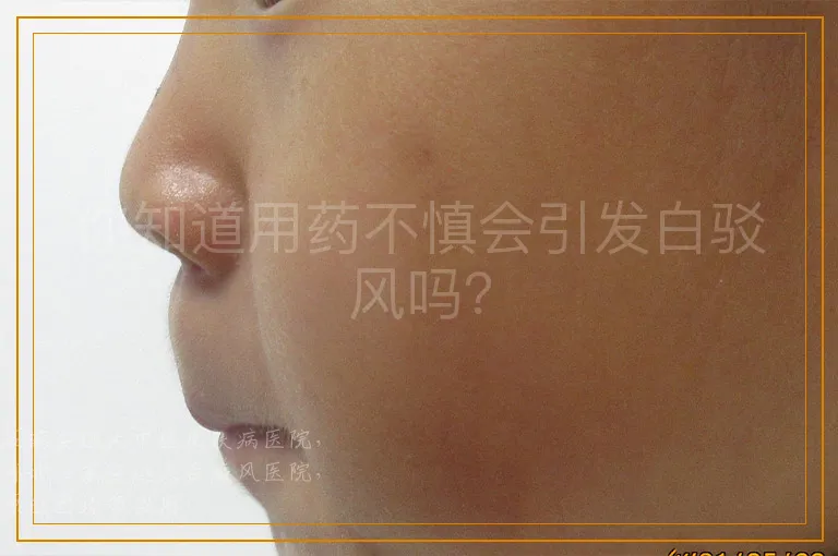 你知道用药不慎会引发白驳风吗？