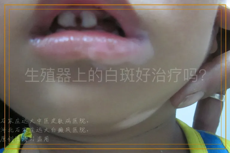 生殖器上的白斑好治疗吗？