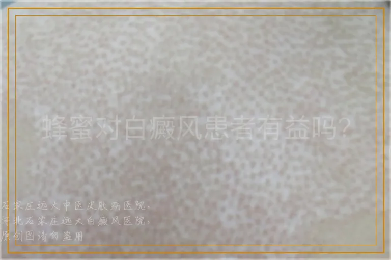 蜂蜜对白癜风患者有益吗？