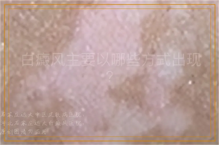 白癜风主要以哪些方式出现？