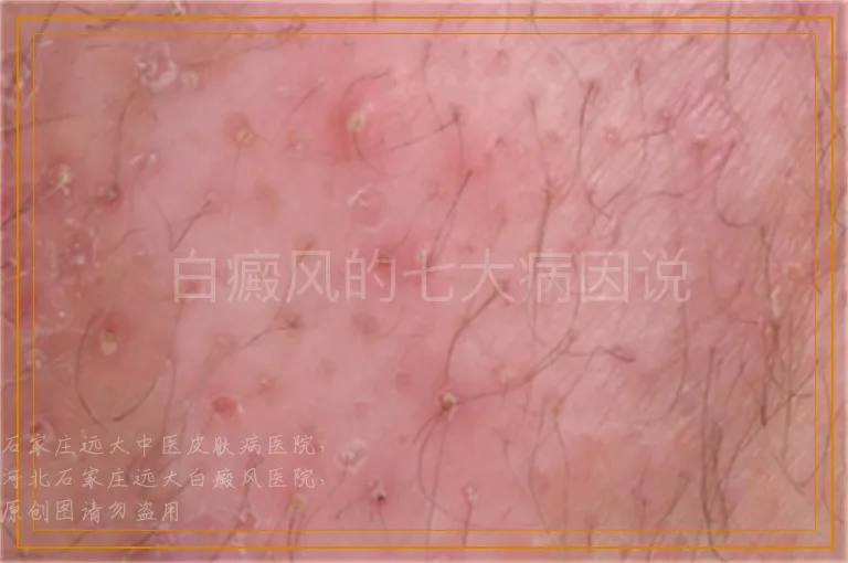 白癜风的七大病因说