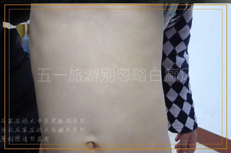 五一旅游别忽略白癜风