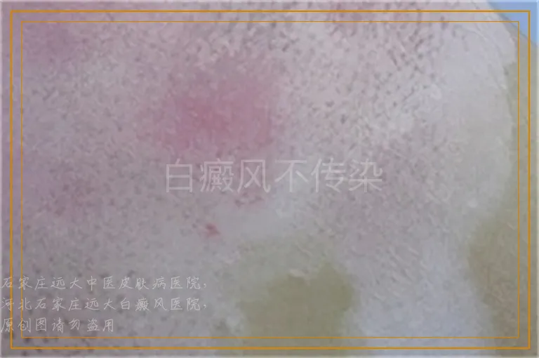 白癜风不传染