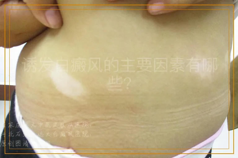 诱发白癜风的主要因素有哪些？
