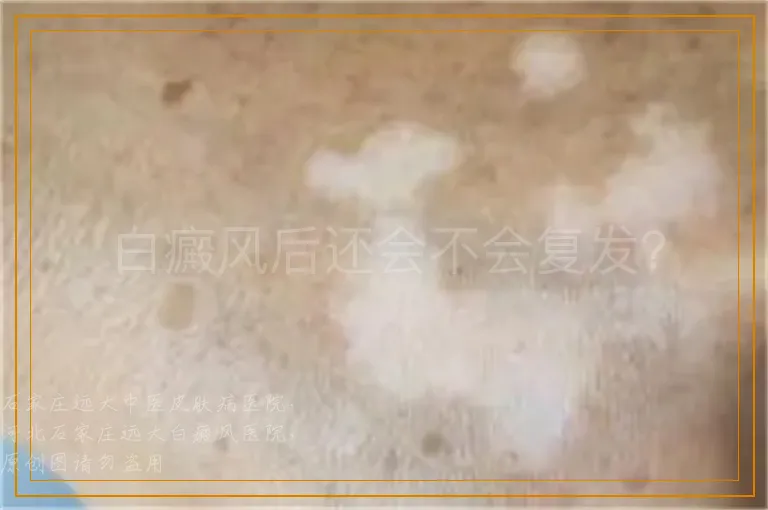 白癜风后还会不会复发？