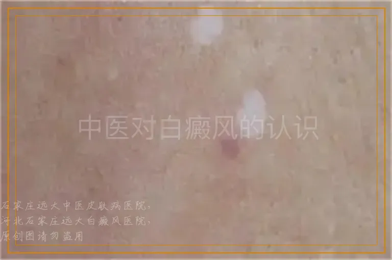 中医对白癜风的认识