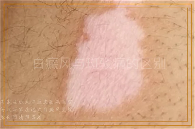 白癜风与斑驳病的区别