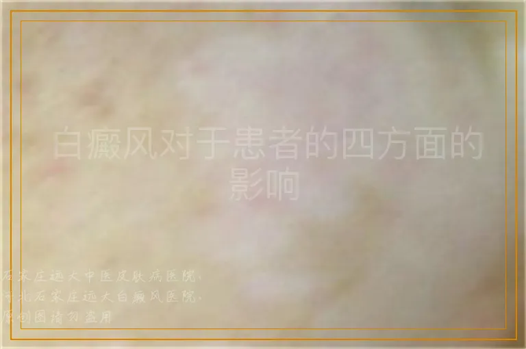 白癜风对于患者的四方面的影响