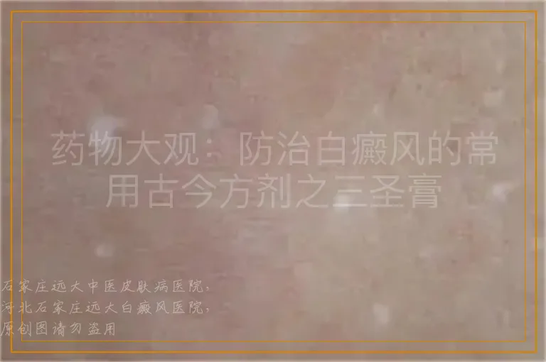 药物大观：防治白癜风的常用古今方剂之三圣膏