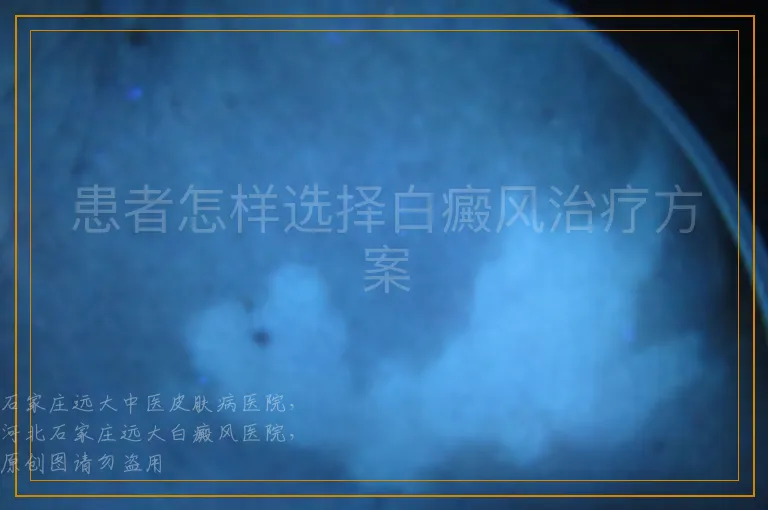 患者怎样选择白癜风治疗方案