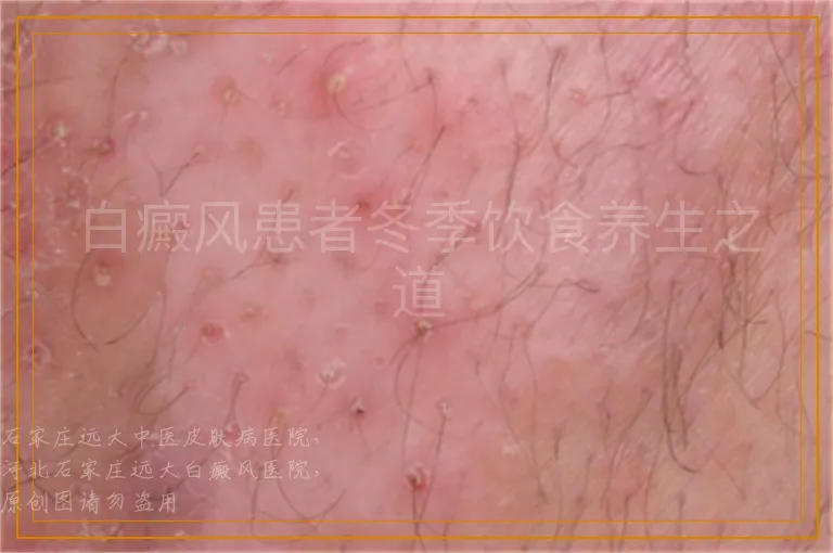 白癜风患者冬季饮食养生之道