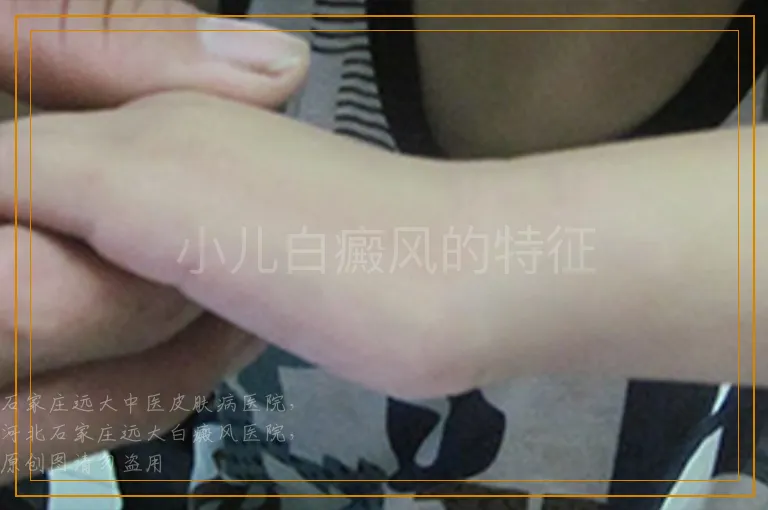 小儿白癜风的特征