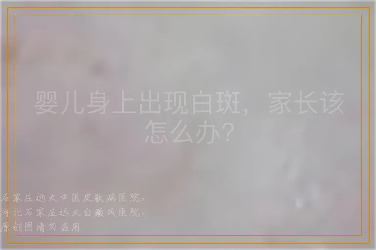 婴儿身上出现白斑，家长该怎么办?