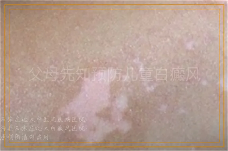 父母先知预防儿童白癜风