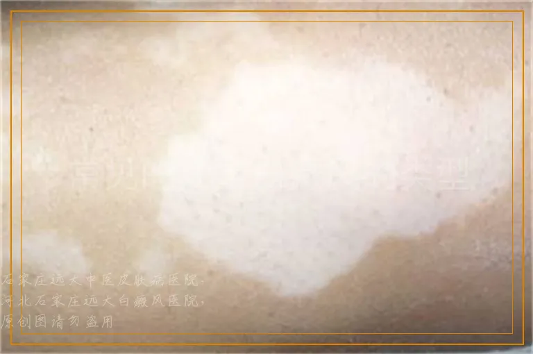 常见的儿童白癜风的类型