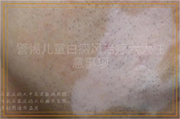 警惕儿童白癜风治疗六大注意事项