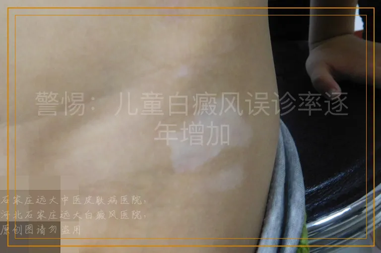 警惕：儿童白癜风误诊率逐年增加