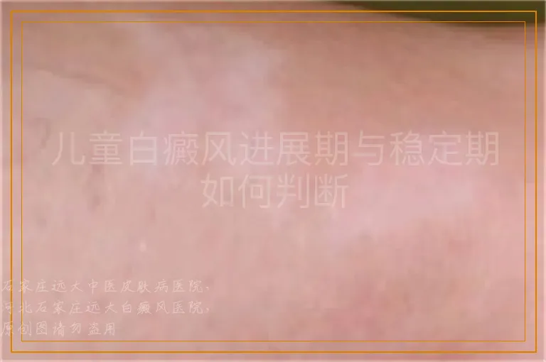 儿童白癜风进展期与稳定期如何判断