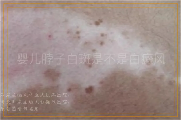 婴儿脖子白斑是不是白癜风