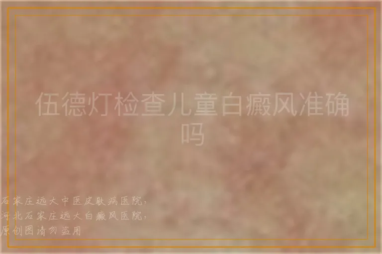 伍德灯检查儿童白癜风准确吗