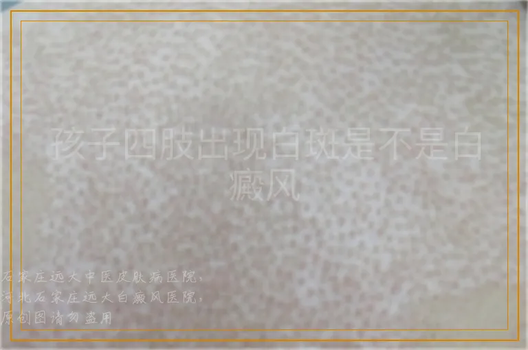 孩子四肢出现白斑是不是白癜风