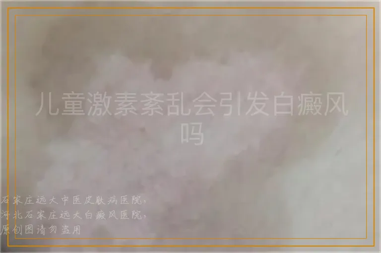 儿童激素紊乱会引发白癜风吗