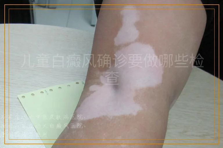 儿童白癜风确诊要做哪些检查