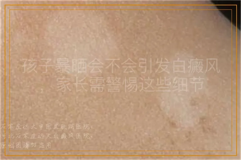 孩子暴晒会不会引发白癜风，家长需警惕这些细节